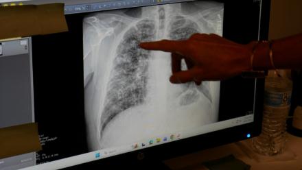 Lisa Emery, directrice du Breathing Center and Black Lung Clinic; montre une radiographie des poumons d'un mineur de charbon souffrant de pneumoconiose, le 13 août 2026 au New River Health, à Oak Hill, en Virginie-Occidentale 