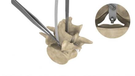 Implanet : premières poses du système JAZZ en Chine