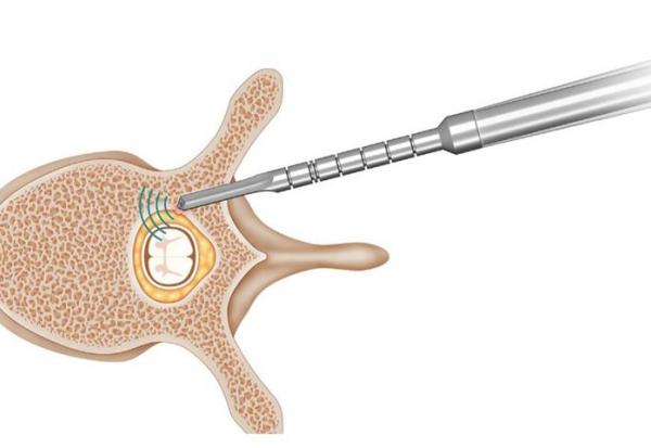 SpineGuard : Lancement d'une augmentation de capital d'un montant brut initial de 1,6 ME