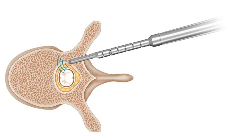SpineGuard : nouveau brevet américain