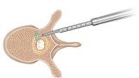 SpineGuard : nouveau brevet américain